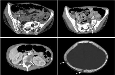 Hypercalcemia and Osteolytic Lesions as Presenting Symptoms of Acute Lymphoblastic Leukemia in Children: Case Report and Literature Review